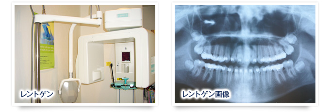 レントゲン／レントゲン画像