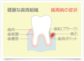 歯周病の症状